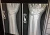 xray broken arms work injury