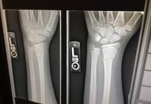 xray broken arms work injury