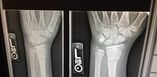 xray broken arms work injury