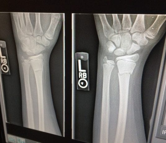 xray broken arms work injury