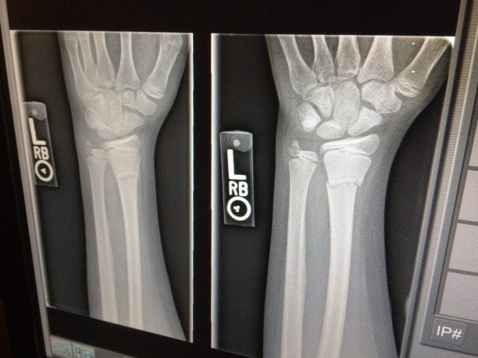 xray broken arms work injury