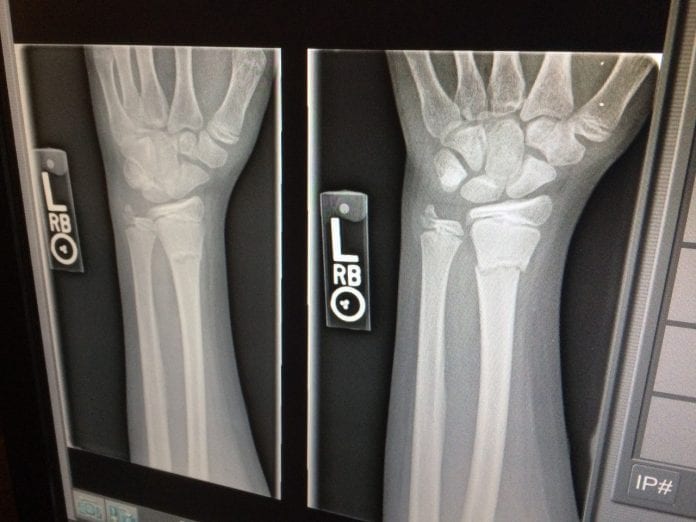 work injury broken bones xray broken arms work injury