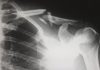 Can a Personal Injury Lawyer Get Me a Better Settlement?