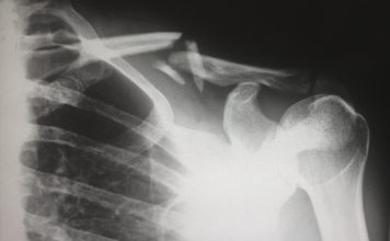 Can a Personal Injury Lawyer Get Me a Better Settlement?